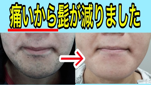 ビキニラインのレーザー脱毛は痛いですか?